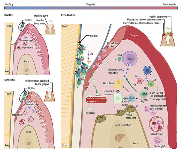 The clinicopathological progression of plaque-induced periodontal diseases