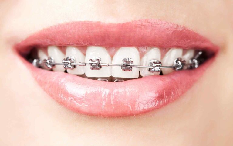 braces