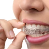 Invisalign - things to look out