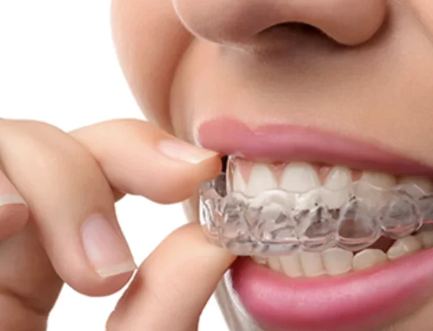 Invisalign – things to look out