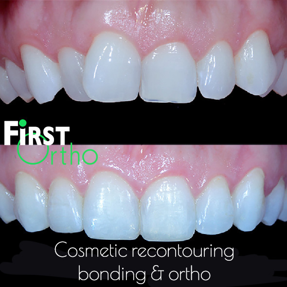 https://firstortho.co.uk/wp-content/uploads/2023/07/Contouring-and-bonding.jpg