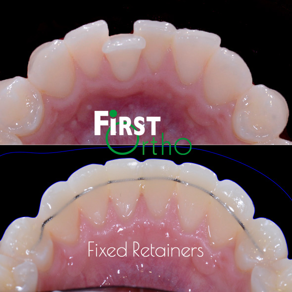 https://firstortho.co.uk/wp-content/uploads/2023/07/Retainers.jpg