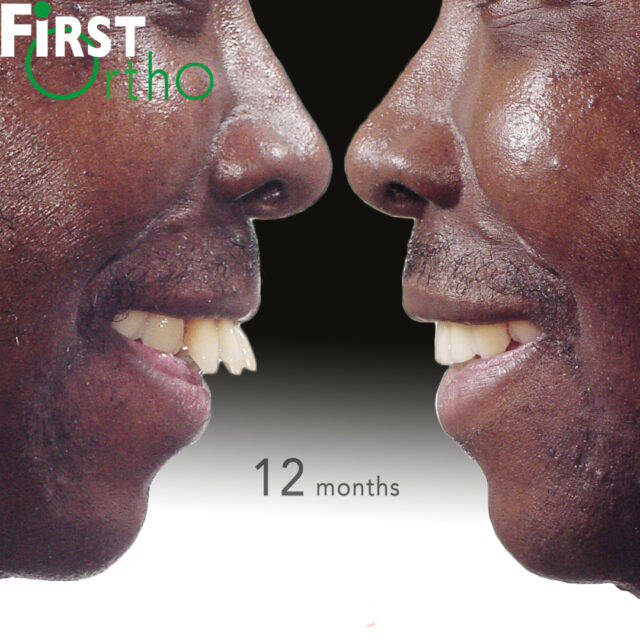 Teeth drifting due to periodontal disorder