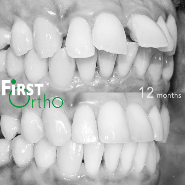 Teeth drifting corrected with orthodontics and periodontal treatment