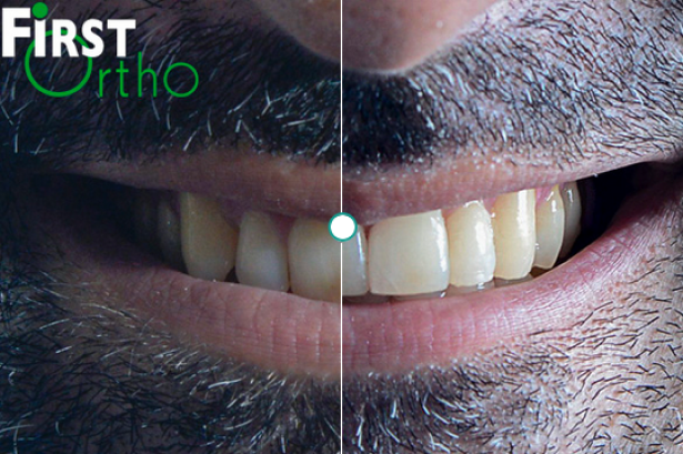 https://firstortho.co.uk/wp-content/uploads/2024/05/before-after-smile-2.png