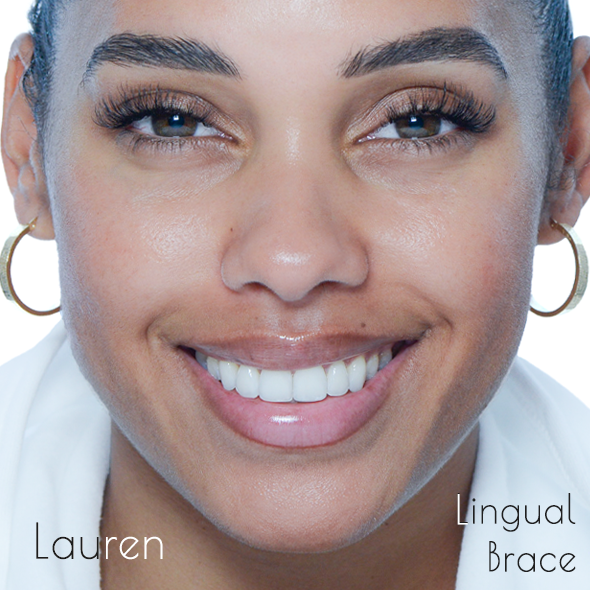 FIRST Ortho adult patient smile transformation